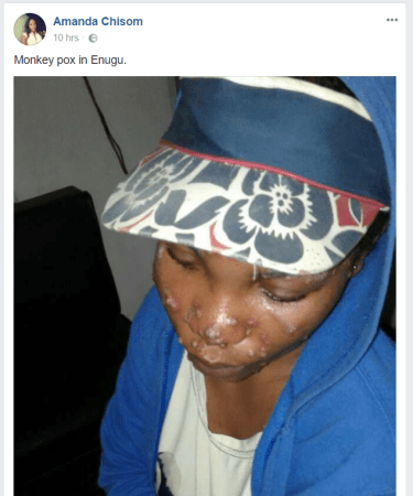 Monkey Pox Hits Enugu Today After Hitting Lagos Yesterday