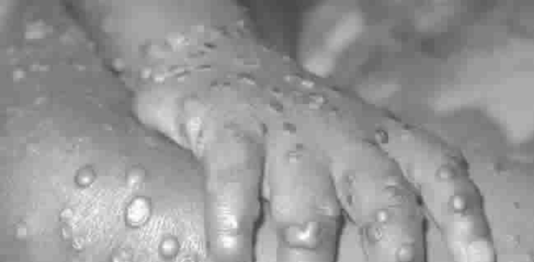 Deadly Viral Disease ‘Monkeypox’ Hits Bayelsa [Disturbing Photos]