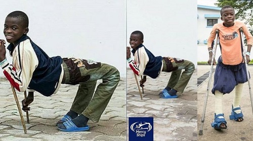 12-Year-Old Boy Full Of Joy After Undergoing Successful Surgery To Correct His Backward Facing Legs