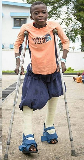 12-Year-Old Boy Full Of Joy After Undergoing Successful Surgery To Correct His Backward Facing Legs