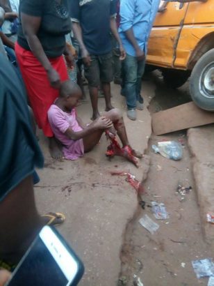 Commercial Bus Cuts Off Young Girl’s Leg In Enugu [Graphic Photos]