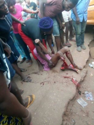 Commercial Bus Cuts Off Young Girl’s Leg In Enugu [Graphic Photos]