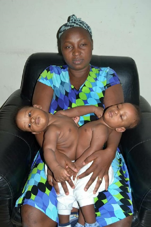 22 Doctors Successfully Separates Nigerian Conjoined Twins Undergo [Photos]
