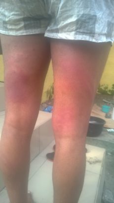 Corp Member Flogged Blue Black In Kebbi After Accused Of Stealing Chickens [Photos]