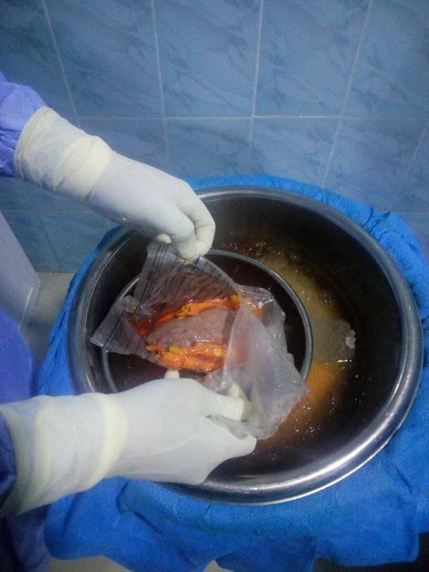 First Ever Successful Kidney Transplant In South East Took Place Yesterday At Popular South Eastern State [Photos]