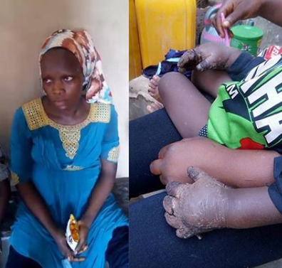 For Eating Her Food, Lady Puts 1-Yr-Old Stepson’s Hands In Hot Water [Photos]