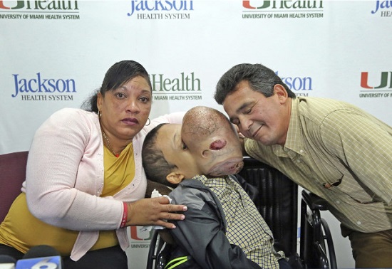 Amazing Transformation As Doctors Removes 10 Pound Tumor Covering The Whole Face Of A Little Boy