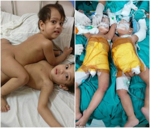How 20 Doctors Separated Conjoined Twins With Surgery That Lasted 12 Hours 