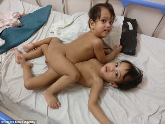 How 20 Doctors Separated Conjoined Twins With Surgery That Lasted 12 Hours 