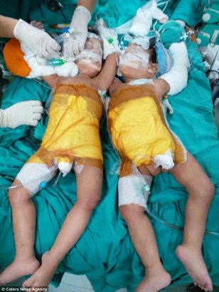 How 20 Doctors Separated Conjoined Twins With Surgery That Lasted 12 Hours 