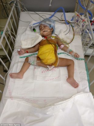 How 20 Doctors Separated Conjoined Twins With Surgery That Lasted 12 Hours 