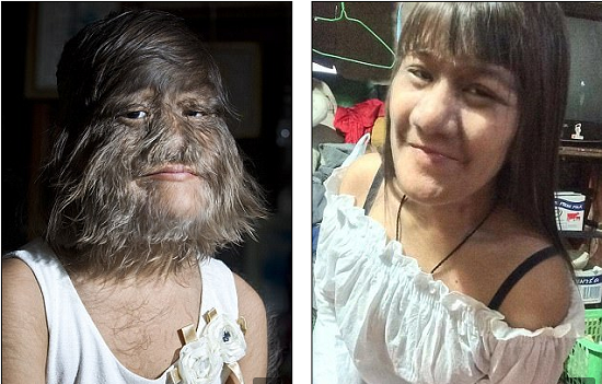 For The First Time Ever, World Hairiest Girl Shaves Off Her Face As She Wants To Get Married 