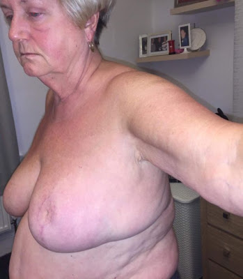 63 Year Old Grandmother, Who Went For A Breast Reduction Is Left With No Nipples After Surgery [Photos]