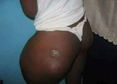 After Result Of Lady That Took Injection In Order To Increase The Size Of Buttocks [Photos]