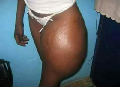 After Result Of Lady That Took Injection In Order To Increase The Size Of Buttocks [Photos]