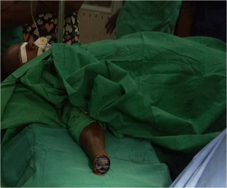 17-Year-Old Lucky Boy Has His Hand Re-Attached by Doctors After It Was Cut Off [Graphic Photos]