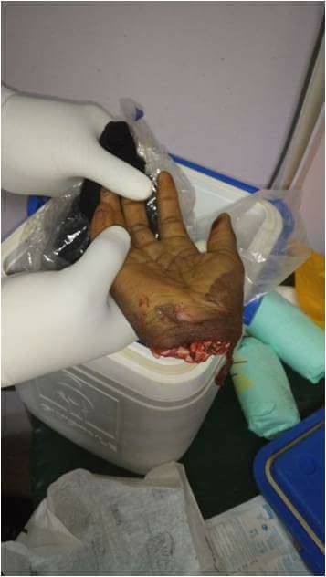 17-Year-Old Lucky Boy Has His Hand Re-Attached by Doctors After It Was Cut Off [Graphic Photos]
