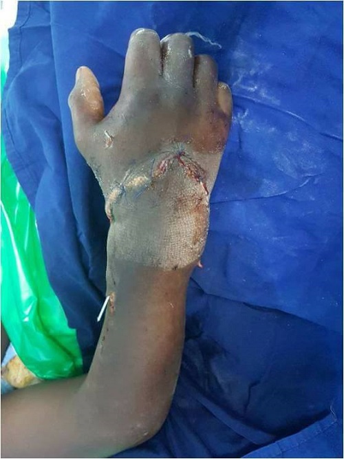 17-Year-Old Lucky Boy Has His Hand Re-Attached by Doctors After It Was Cut Off [Graphic Photos]