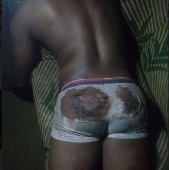 Man’s Buttocks Bloodied After He Was Allegedly Brutalised by Immigration Officer
