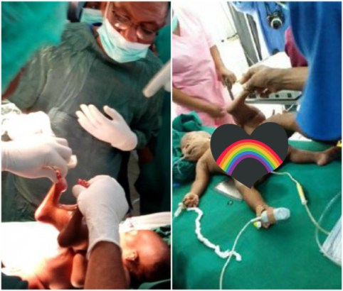 One Dies After Conjoined Twins Was Separated in Bauchi State