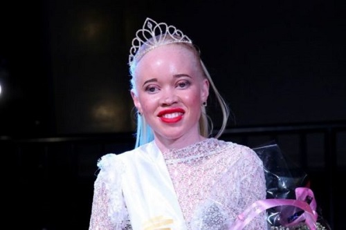 Chai!!!Zimbabwe’s Miss Albino Beauty Pageant, Winner Gets $85 Chai!!!Zimbabwe’s Miss Albino Beauty Pageant, Winner Gets $85