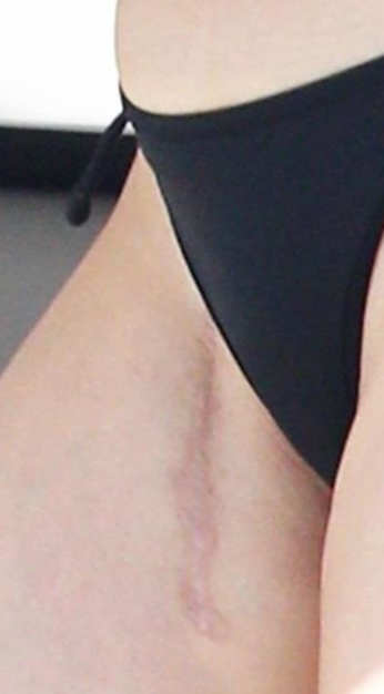 Selena Gomez Spotted Wearing Bikini That Displayed Her Surgery Scars [Photos]