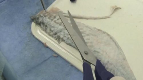 Lady Born Without Vagina Finally Has One Made Out Of Fish Skin [Photos]