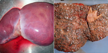 Photo: Check Out A Healthy Liver and The One Damaged By Alcohol