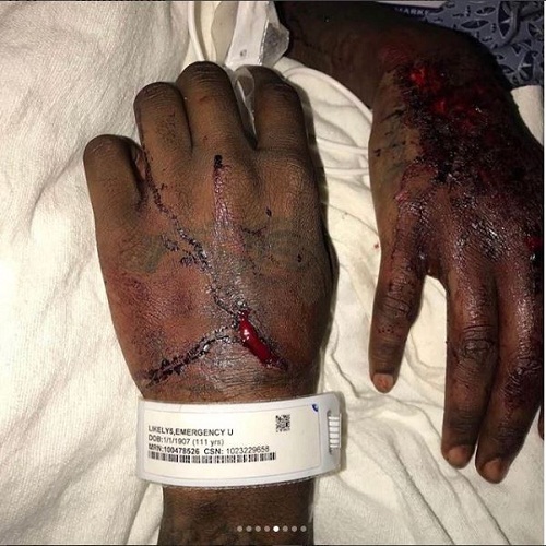 Rapper, offset says he could have been dead as he shows injuries he suffered after his car crash in Atlanta [Graphic Photos]