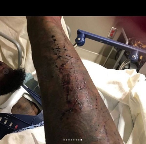 Rapper, offset says he could have been dead as he shows injuries he suffered after his car crash in Atlanta [Graphic Photos]