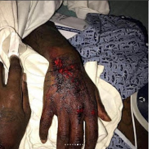 Rapper, offset says he could have been dead as he shows injuries he suffered after his car crash in Atlanta [Graphic Photos]