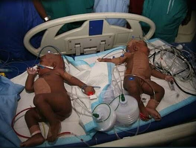 Endless Celebration As FMC Yola Separates Conjoined Female Twins [Photos]