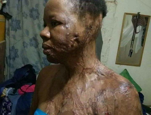 UNIZIK Graduate, Nkiruka Jane Nnaji, Bathed With Acid By An Unknown Man [photos]