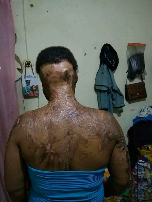 UNIZIK Graduate, Nkiruka Jane Nnaji, Bathed With Acid By An Unknown Man [photos]
