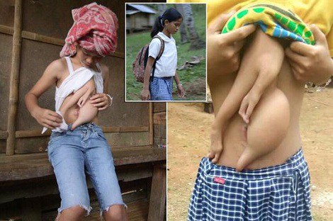 14-Year Old Girl Growing an Extra Arm on Her Chest [SEE SHOCKING PHOTOS]