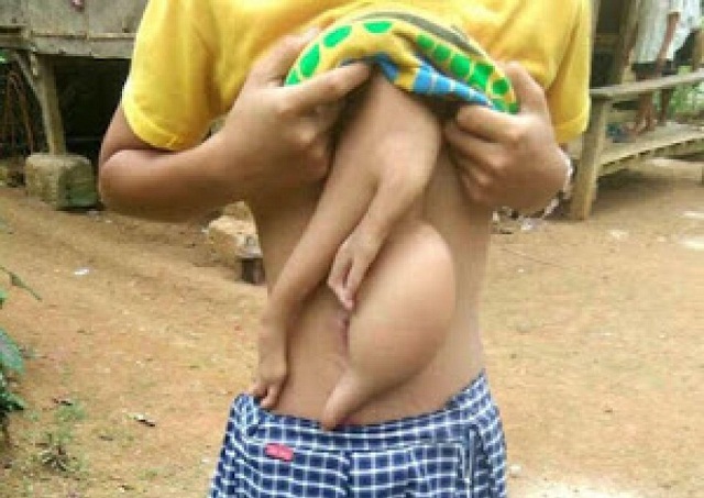 14-Year Old Girl Growing an Extra Arm on Her Chest [SEE SHOCKING PHOTOS]