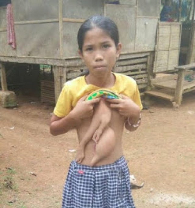 14-Year Old Girl Growing an Extra Arm on Her Chest [SEE SHOCKING PHOTOS]