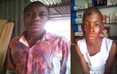 Heartless Mother Burns her 10-Year-Old Daughter’s Face with Electric Iron over Missing 200 Naira [Photos]