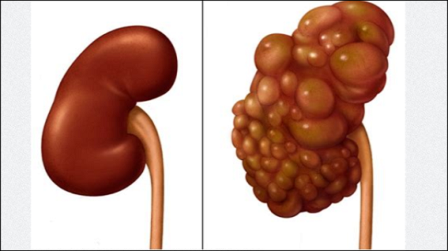 5 Ways to Keep Your Kidney Healthy, Number 5 Is Very Important [Must Read]