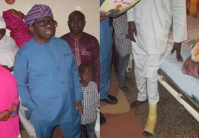 Minister of Health Visits Abubakar Duduwale, the Man Who Developed Leg Injury Years after Trekking From Yola to Abuja To Honor Buhari