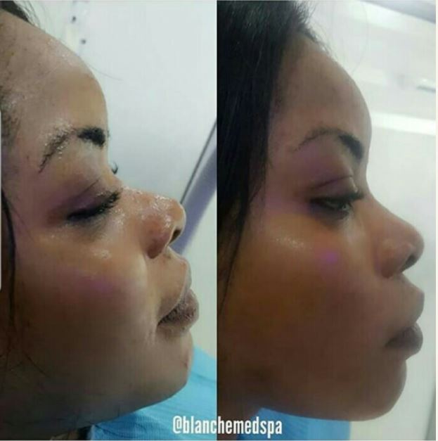 Photos Of Laura Ikeji As She Undergoes A Nose Lift Cosmetic Surgery