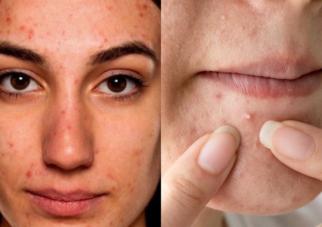 9 Things You Should Never Use On A Pimple, According To Dermatologists