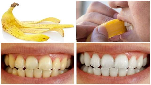 4 Ways to Naturally Whiten the Teeth Using Banana Peels