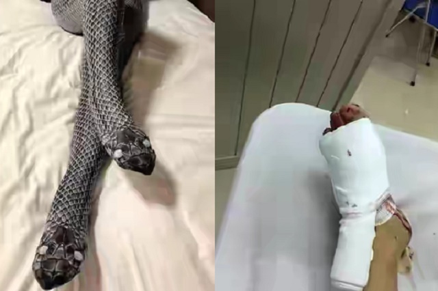 Man Breaks His Wife's Legs Thinking It Was Snake Heads