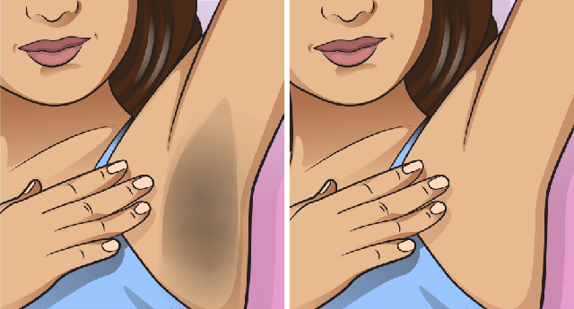 6 Cheap, Natural and Effective Ways to Deal with Dark Underarms