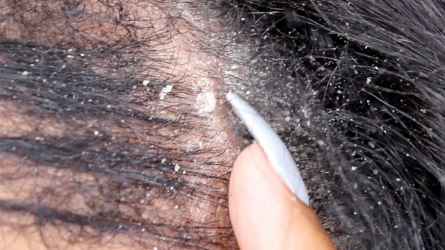 6 Major Causes of Dandruff You Should Know About