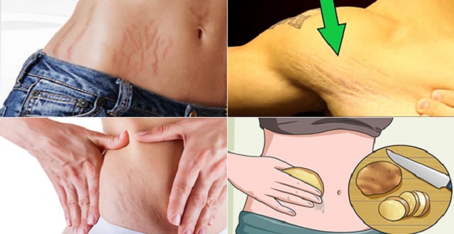 6 Natural Remedies to Remove Stretch Marks within 3 Weeks