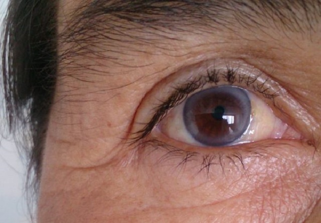 9 Things Your Eyes Say about Your Health [If You See Grey Ring around Your Cornea, Watch Out]