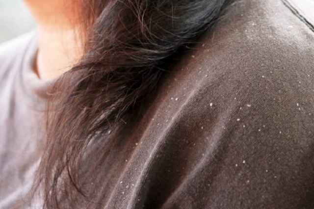 8 Things Your Hair Says About Your Health [#7 Can Cause Weak Hair]