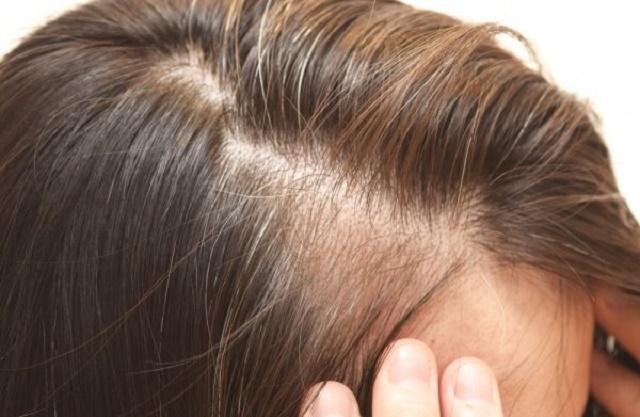 8 Things Your Hair Says About Your Health [#7 Can Cause Weak Hair]